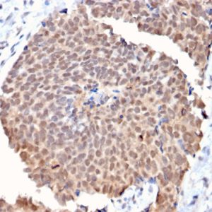 Formalin-fixed, paraffin-embedded human Breast Cancer stained with FAF1 Mouse Monoclonal Antibody (CPTC-FAF1-2).
