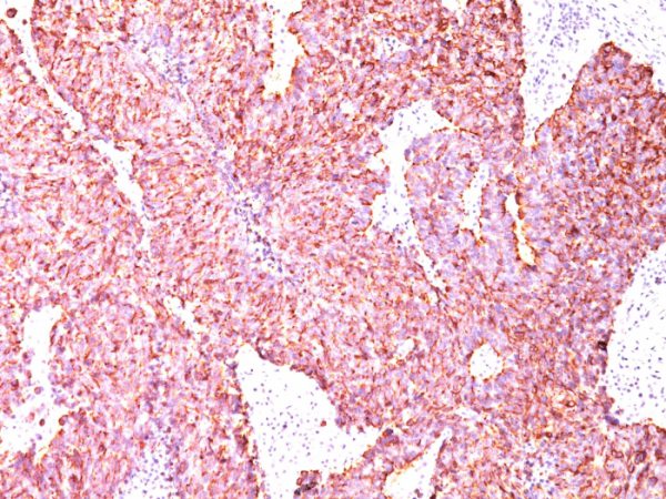 Formalin-fixed, paraffin-embedded human Small Cell Lung Carcinoma stained with Chromogranin A Mouse Monoclonal Antibody (CGA/414).