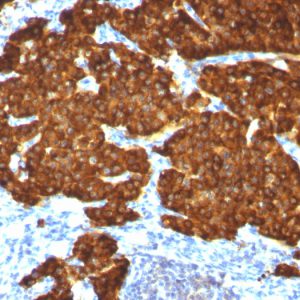 Formalin-fixed, paraffin-embedded Pheochromocytoma stained with Chromogranin A Monoclonal Antibody (CGA/413+ CHGA/777+ CHGA/798)