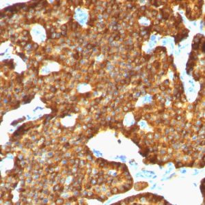 Formalin-fixed, paraffin-embedded human Pheochromocytoma stained with Chromogranin A Mouse Monoclonal Antibody (SPM553).