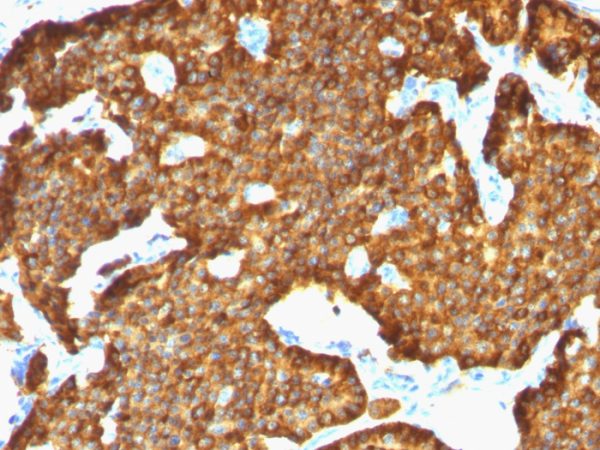 Formalin-fixed, paraffin-embedded human Pheochromocytoma stained with Chromogranin A Mouse Monoclonal Antibody (SPM553).