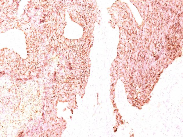Formalin-fixed, paraffin-embedded human Small Cell Lung Carcinoma stained with Chromogranin A Monoclonal Antibody (LK2H10)