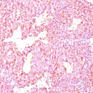 Formalin-fixed, paraffin-embedded human Small Cell Lung Carcinoma stained with Chromogranin A Monoclonal Antibody (LK2H10 + PHE5)