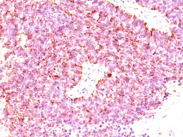 Formalin-fixed, paraffin-embedded human Small Cell Lung Carcinoma stained with Chromogranin A Monoclonal Antibody (LK2H10+PHE5+CGA414)