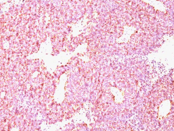 Formalin-fixed, paraffin-embedded human SC Lung Carcinoma stained with Chromogranin A Monoclonal Antibody (CHGA/798)