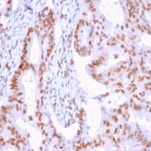 Formalin-fixed, paraffin-embedded human Breast Carcinoma stained with CLEC9A Mouse Monoclonal Antibody (2H12/4).