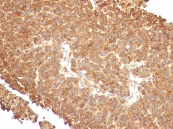 Formalin-fixed, paraffin-embedded human melanoma stained with Topo I, MT Mouse Monoclonal Antibody (TOP1MT/488).