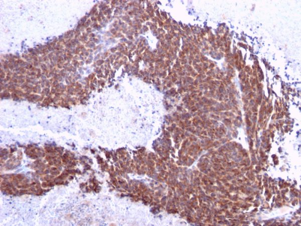 Formalin-fixed, paraffin-embedded human Melanoma stained with Topo I, MT Mouse Monoclonal Antibody (TOP1MT/613).