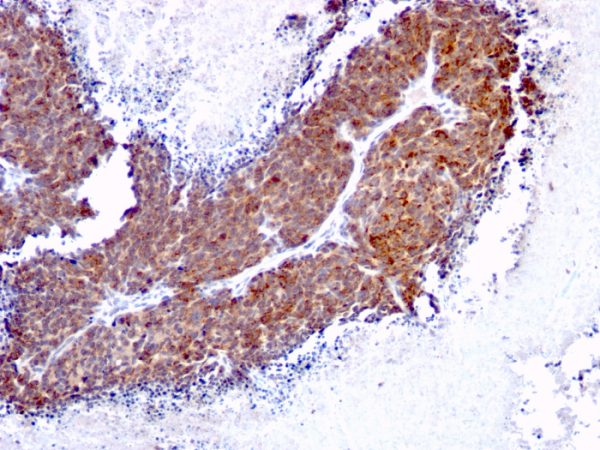 Formalin-fixed, paraffin-embedded human Melanoma stained with Topo I, MT Mouse Monoclonal Antibody (TOP1MT/613).