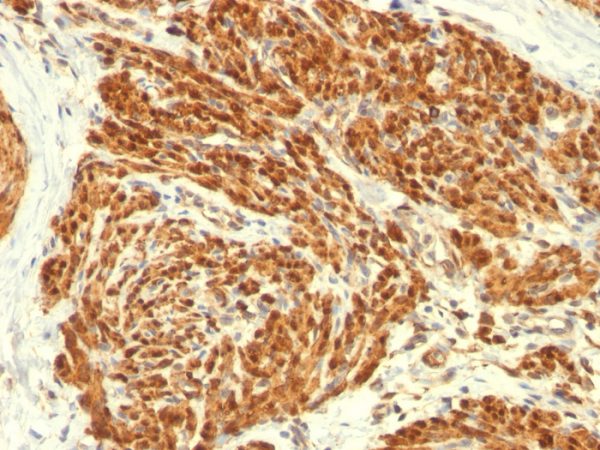 Formalin-fixed, paraffin-embedded human Uterus stained with Calponin-1 Mouse Monoclonal Antibody (CALP).