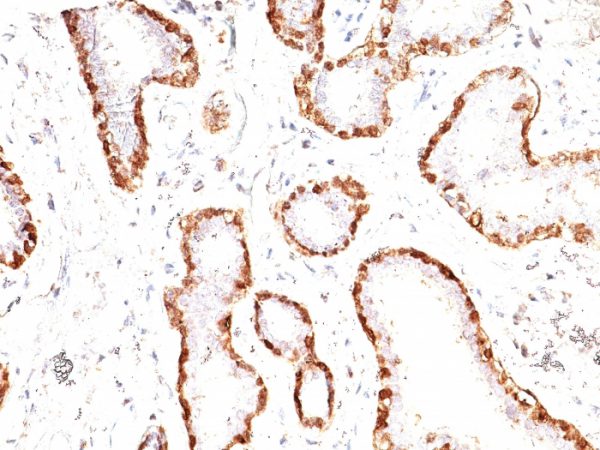Formalin-fixed, paraffin-embedded human Breast Carcinoma stained with Calponin-1 Mouse Monoclonal Antibody (CNN1/832).
