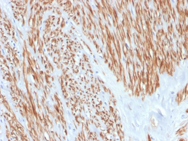 Formalin-fixed, paraffin-embedded human leiomyosarcoma stained with Calponin Rabbit Recombinant Monoclonal Antibody (CNN1/4227R).