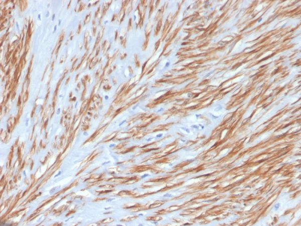 Formalin-fixed, paraffin-embedded human leiomyosarcoma stained with Calponin Rabbit Recombinant Monoclonal Antibody (CNN1/4227R).