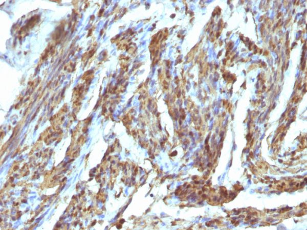 Formalin-fixed, paraffin-embedded human Uterus stained with Calponin Rabbit Polyclonal Antibody