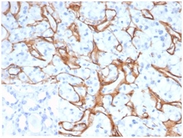Formalin-fixed, paraffin-embedded human kidney adenocarcinoma. Strong staining of glomeruli using M3F7 at 2ug/ml in PBS for 30min RT. Inset: PBS instead of primary antibody, secondary negative control.