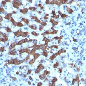 Formalin-fixed, paraffin-embedded human Hepatocellular Ca stained with CPS1 Monoclonal Antibody (CPS1/1022).