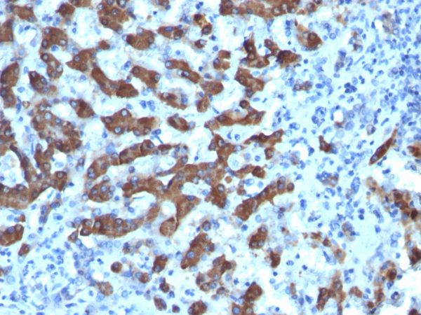 Formalin-fixed, paraffin-embedded human hepatocellular carcinoma stained with CPS1 Mouse Monoclonal Antibody (CPS1/1022).