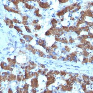 Formalin-fixed, paraffin-embedded human Hepatocellular Ca stained with CPS1 Monoclonal Antibody (SPM615).