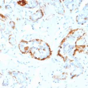 Formalin-fixed, paraffin-embedded human Breast stained with Crystallin Alpha B Mouse Monoclonal Antibody (CPTC-CYRAB-1).