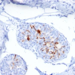 Formalin-fixed, paraffin-embedded human Breast Carcinoma stained with ZNF690 / ZSCAN29 Mouse Monoclonal Antibody (ZSCAN29/2610).