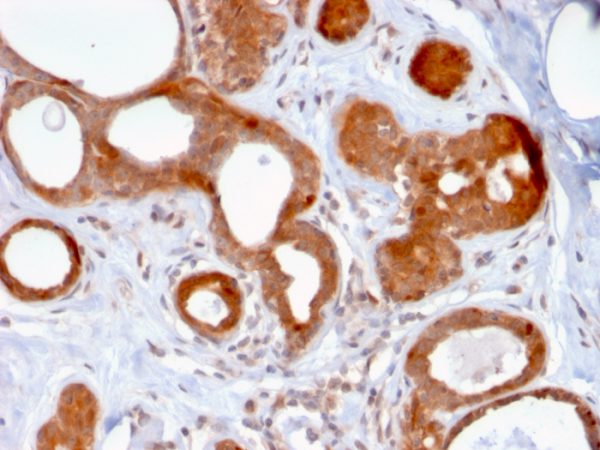 Formalin-fixed, paraffin-embedded human Breast Carcinoma stained with ZNF690 / ZSCAN29 Mouse Monoclonal Antibody (ZSCAN29/2610).