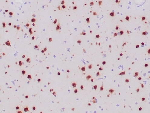 Formalin-fixed, paraffin-embedded human ganglioma stained with NeuN Recombinant Rabbit Monoclonal Antibody (NeuN/6694R).