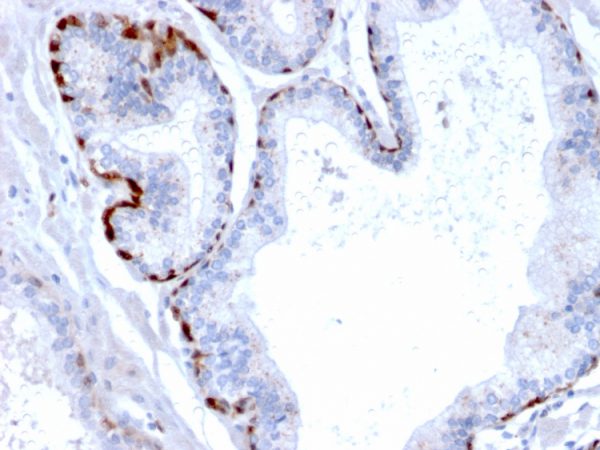 Formalin-fixed, paraffin-embedded human Prostate Carcinoma stained with Cystatin A Mouse Monoclonal Antibody (CPTC-CSTA-1).