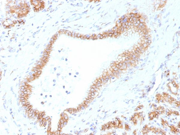 Formalin-fixed, paraffin-embedded human Pancreas stained with Beta-Catenin (p120) Monoclonal Antibody (CTNNB1/1507).