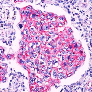 Formalin-fixed, paraffin-embedded breast ductal carcinoma stained with Catenin, beta PAb. Note membrane staining in ductal carcinoma.