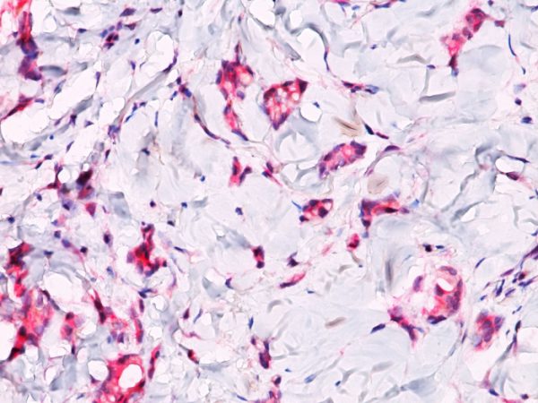 Formalin-fixed, paraffin-embedded breast lobular carcinoma stained with Catenin, beta PAb. Note cytoplasmic staining in lobular carcinoma.
