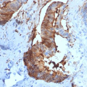 Formalin-fixed, paraffin-embedded human Renal Cell Carcinoma stained with Cathepsin D Mouse Monoclonal Antibody (CTSD/2781).