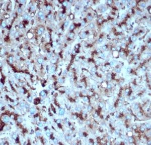 Formalin-fixed, paraffin-embedded human liver carcinoma in colonstained with Cathepsin DMouse Monoclonal Antibody (CTSD/4497).