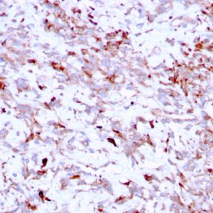 Formalin-fixed, paraffin-embedded human Liver Carcinoma stained with Cathepsin K Mouse Monoclonal Antibody (CTSK/2791).