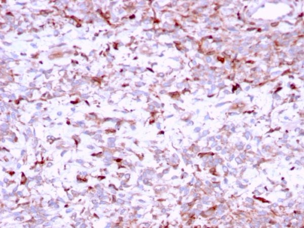 Formalin-fixed, paraffin-embedded human Liver Carcinoma stained with Cathepsin K Mouse Monoclonal Antibody (CTSK/2791).
