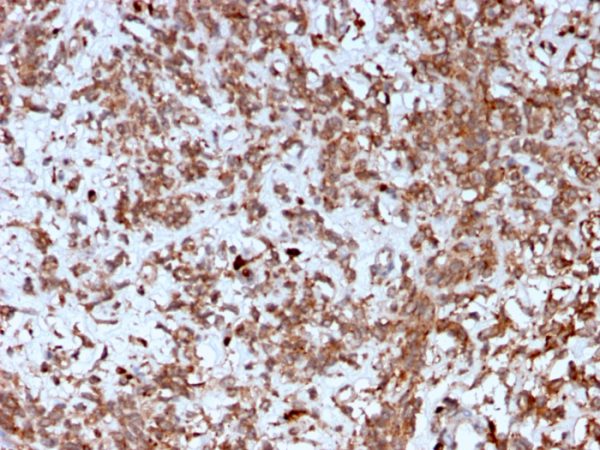 Formalin-fixed, paraffin-embedded human Liver stained with Cathepsin K Mouse Monoclonal Antibody (CTSK/2792).