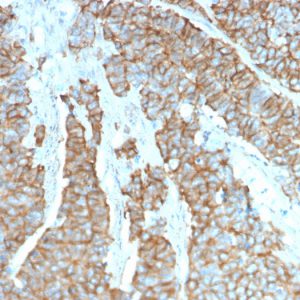 Formalin-fixed, paraffin-embedded human Neuroendocrine Tumor stained with Drebrin-1 Mouse Monoclonal Antibody (DBN1/3393).