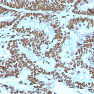 Formalin-fixed, paraffin-embedded human Breast Carcinoma stained with ZNF690 / ZSCAN29 Mouse Monoclonal Antibody (ZNF846/2687).