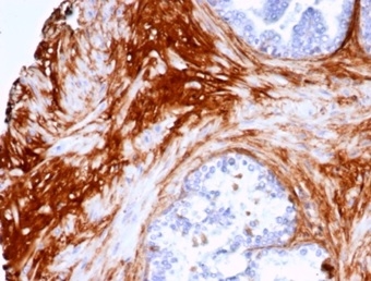 Formalin-fixed, paraffin-embedded human prostate carcinoma stained with Decorin Rabbit Recombinant Monoclonal Antibody (DCN/7031R).