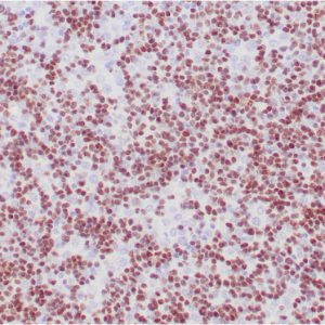 Formalin-fixed, paraffin-embedded human thymomastained with TdT Monospecific Mouse Monoclonal Antibody (TDT/1393).