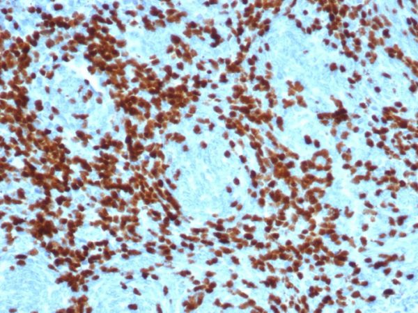 Formalin-fixed, paraffin-embedded human thymoma stained with TdT Recombinant Rabbit Monoclonal Antibody (DNTT/4617R).