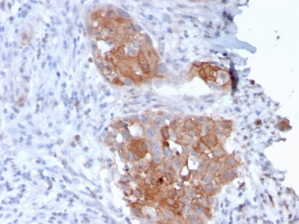 Formalin-fixed, paraffin-embedded human Bladder Carcinoma stained with Desmoglein-1 Mouse Monoclonal Antibody (32-2B).