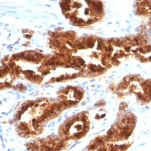 Formalin-fixed, paraffin-embedded human Prostate Carcinoma stained with TAG-72 Mouse Monoclonal Antibody (B72.3).