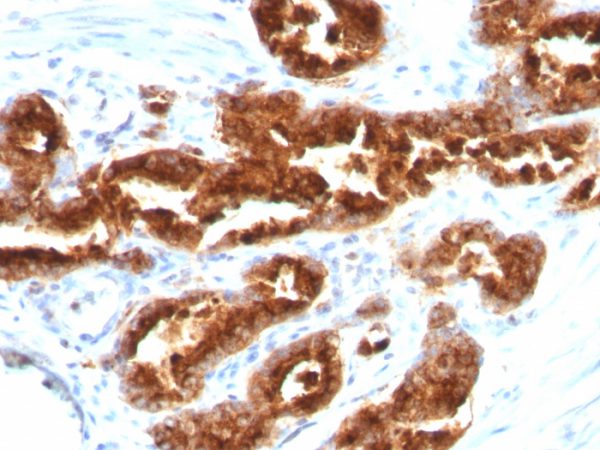 Formalin-fixed, paraffin-embedded human Prostate Carcinoma stained with TAG-72 Mouse Monoclonal Antibody (B72.3).