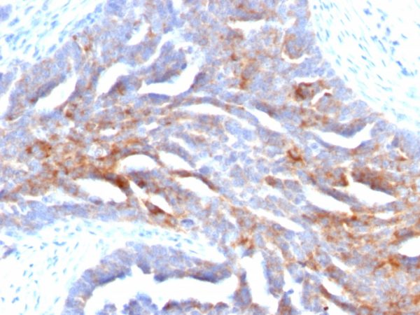 Formalin-fixed, paraffin-embedded human Ovarian Carcinoma stained with TAG-72 Mouse Monoclonal Antibody (B72.3).
