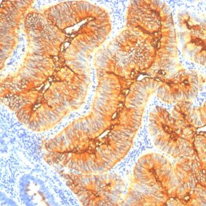 Formalin-fixed, paraffin-embedded human Colon Carcinoma stained with TAG-72 Monoclonal Antibody (SPM148).