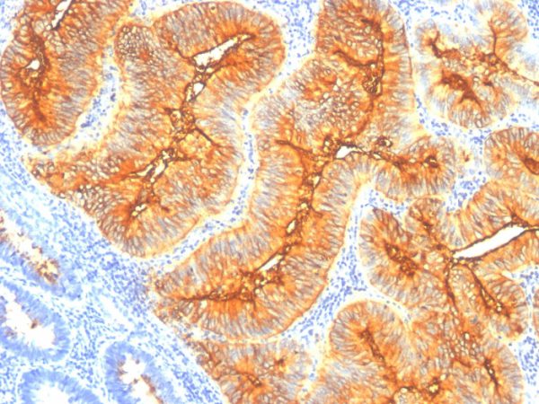 Formalin-fixed, paraffin-embedded human Colon Carcinoma stained with TAG-72 Monoclonal Antibody (SPM148).