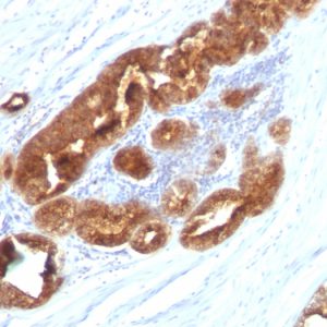 Formalin-fixed, paraffin-embedded human Prostate Carcinoma stained with TAG-72 Monoclonal Antibody (CC49).