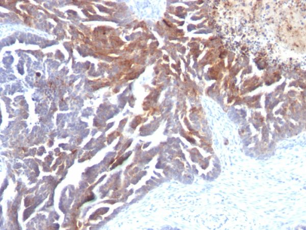 Formalin-fixed, paraffin-embedded human Ovarian Carcinoma stained with TAG-72 Monoclonal Antibody (CC49).