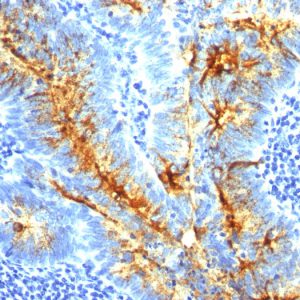 Formalin-fixed, paraffin-embedded human Colon Carcinoma stained with TAG-72 Monoclonal Antibody (SPM536).