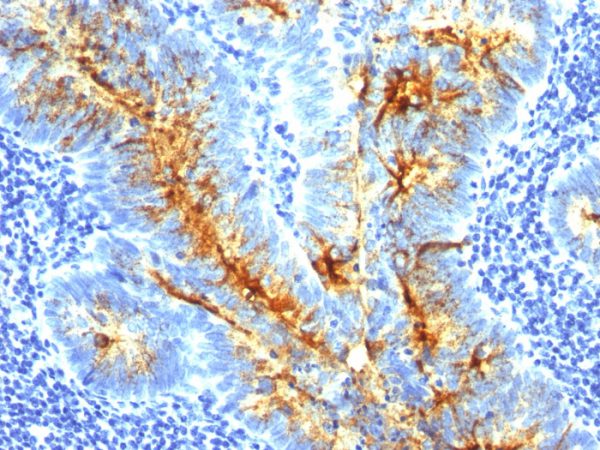 Formalin-fixed, paraffin-embedded human Colon Carcinoma stained with TAG-72 Monoclonal Antibody (SPM536).